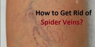 how to get rid of spider veins