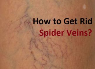 how to get rid of spider veins