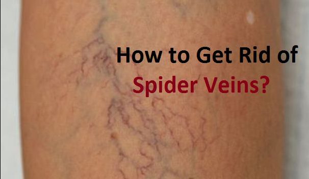 how to get rid of spider veins