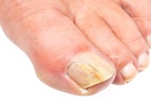 how to get rid of toenail fungus