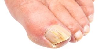 how to get rid of toenail fungus