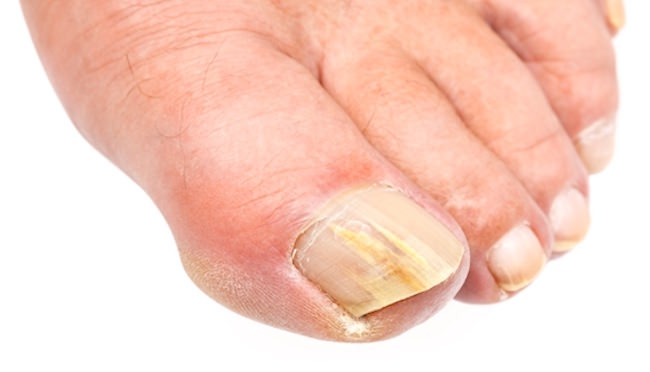 how to get rid of toenail fungus