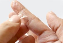 how to get super glue off skin