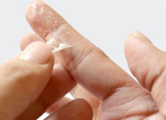 how to get super glue off skin