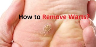 how to remove warts