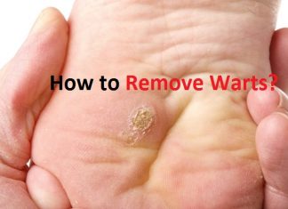 how to remove warts