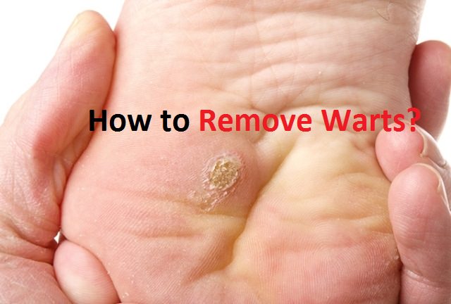 how to remove warts