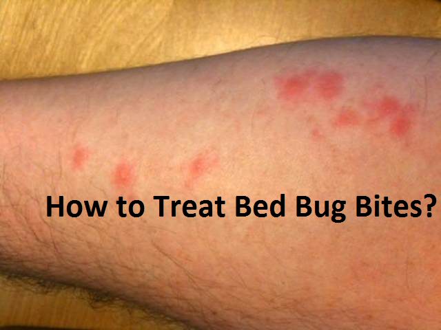 how-to-treat-bed-bug-bites