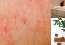 how to treat eczema