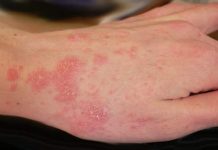 how to get rid of scabies