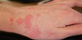 how to get rid of scabies