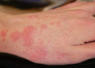 how to get rid of scabies