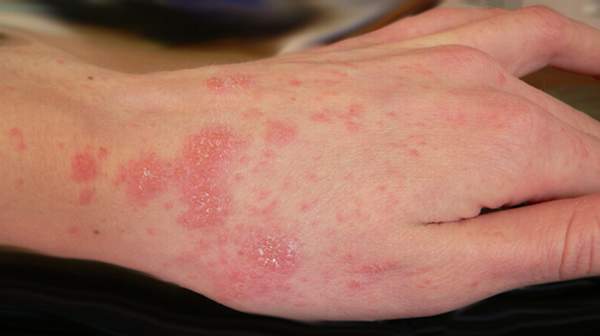 how to get rid of scabies