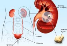how to get rid of kidney stones