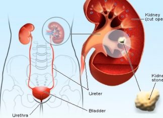 how to get rid of kidney stones