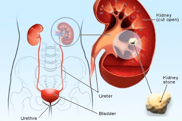 how to get rid of kidney stones