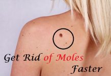 ways to remove moles