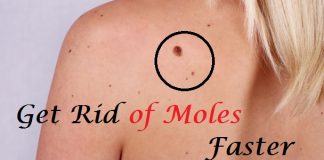 ways to remove moles