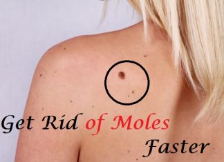 ways to remove moles