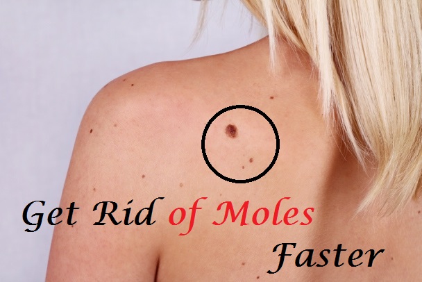 ways to remove moles