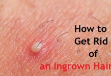 how to get rid of an ingrown hair