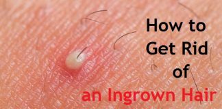 how to get rid of an ingrown hair