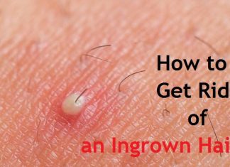 how to get rid of an ingrown hair