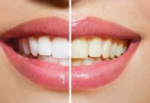 how to whiten teeth fast at home