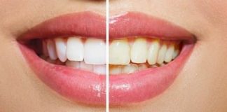 how to whiten teeth fast at home