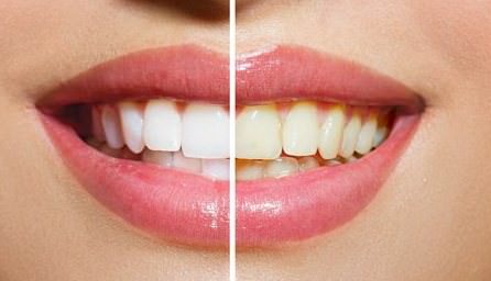 how to whiten teeth fast at home