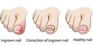 Ingrown toenail home treatment