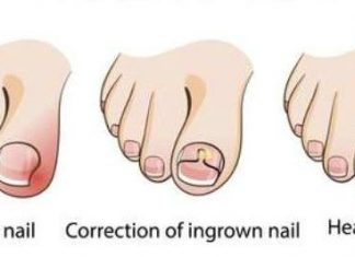 Ingrown toenail home treatment