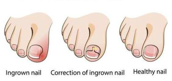 Ingrown toenail home treatment