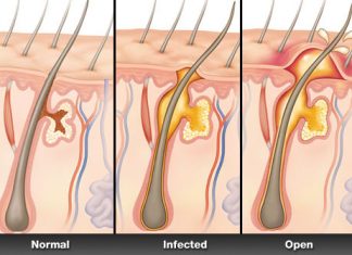 home remedies for boils