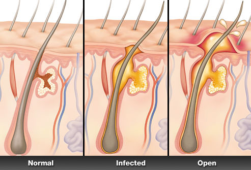 home remedies for boils