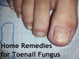 home remedies for toenail fungus