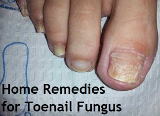 home remedies for toenail fungus