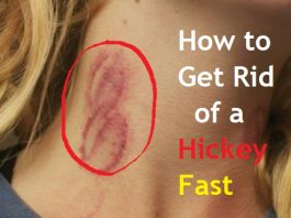 how to get rid of a hickey fast