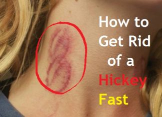 how to get rid of a hickey fast