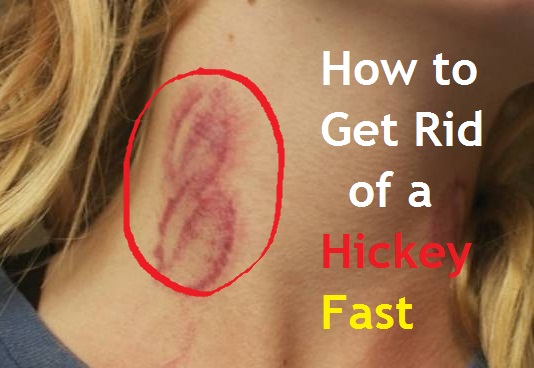 How to Get Rid of a Hickey Fast? 