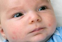 how to get rid of baby acne