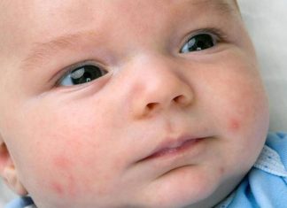 how to get rid of baby acne