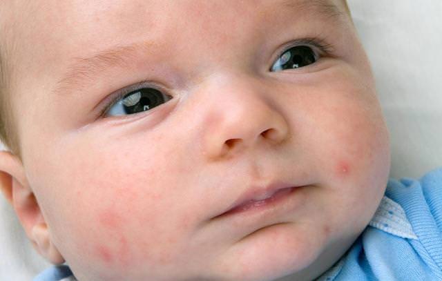 how to get rid of baby acne