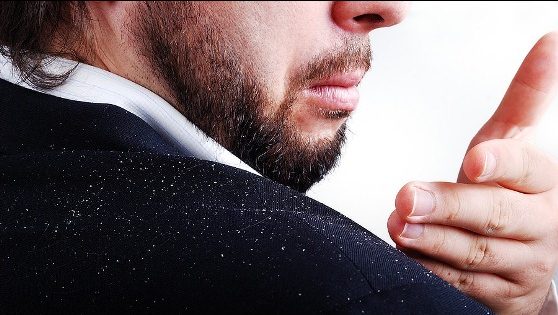 how to get rid of dandruff