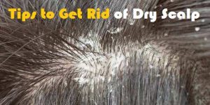 How to Get Rid of Dry Scalp?