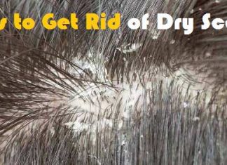 how to get rid of dry scalp