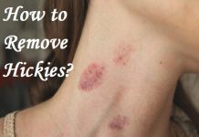 how to remove hickies