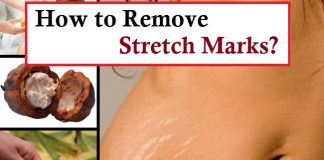 how to remove stretch marks