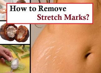 how to remove stretch marks