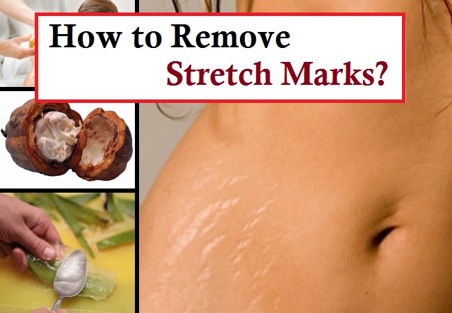 how to remove stretch marks